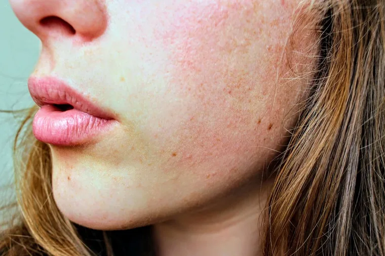 Lábios e contorno facial, áreas trabalhadas no preenchimento com ácido hialurônico