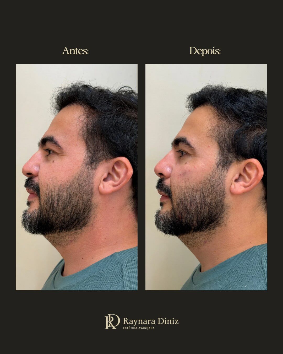 Antes e depois de harmonização facial (perfil) na Clínica Raynara Diniz, Fortaleza