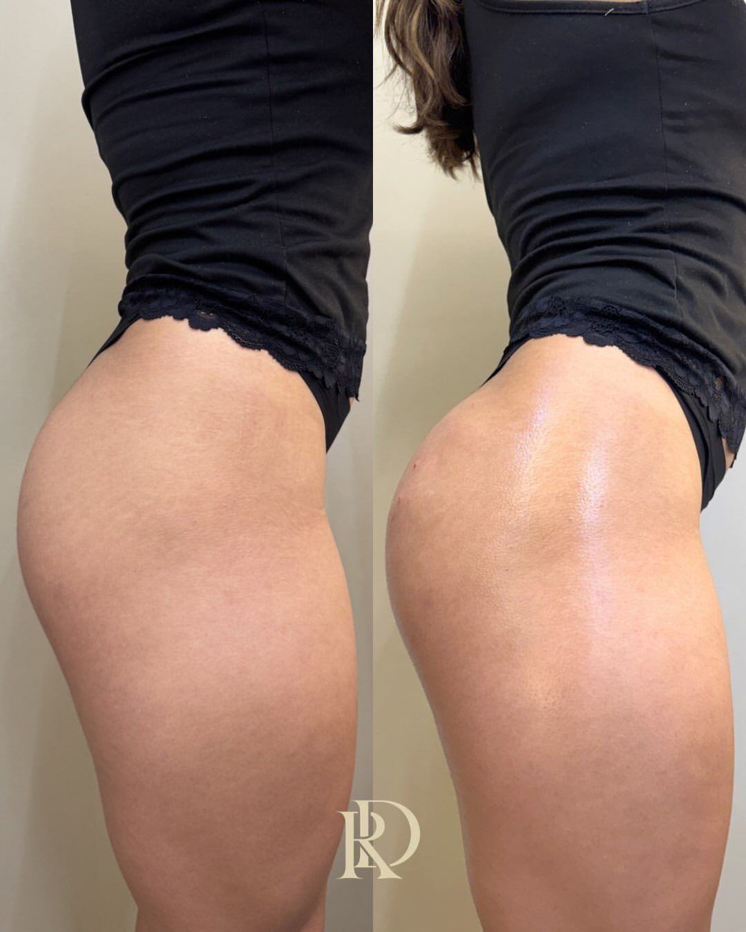 Antes e depois de procedimento corporal de contorno de glúteos na Clínica Raynara Diniz, Fortaleza