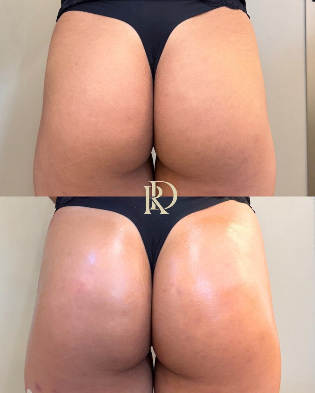 Antes e depois de procedimento corporal de glúteos na Clínica Raynara Diniz, Fortaleza
