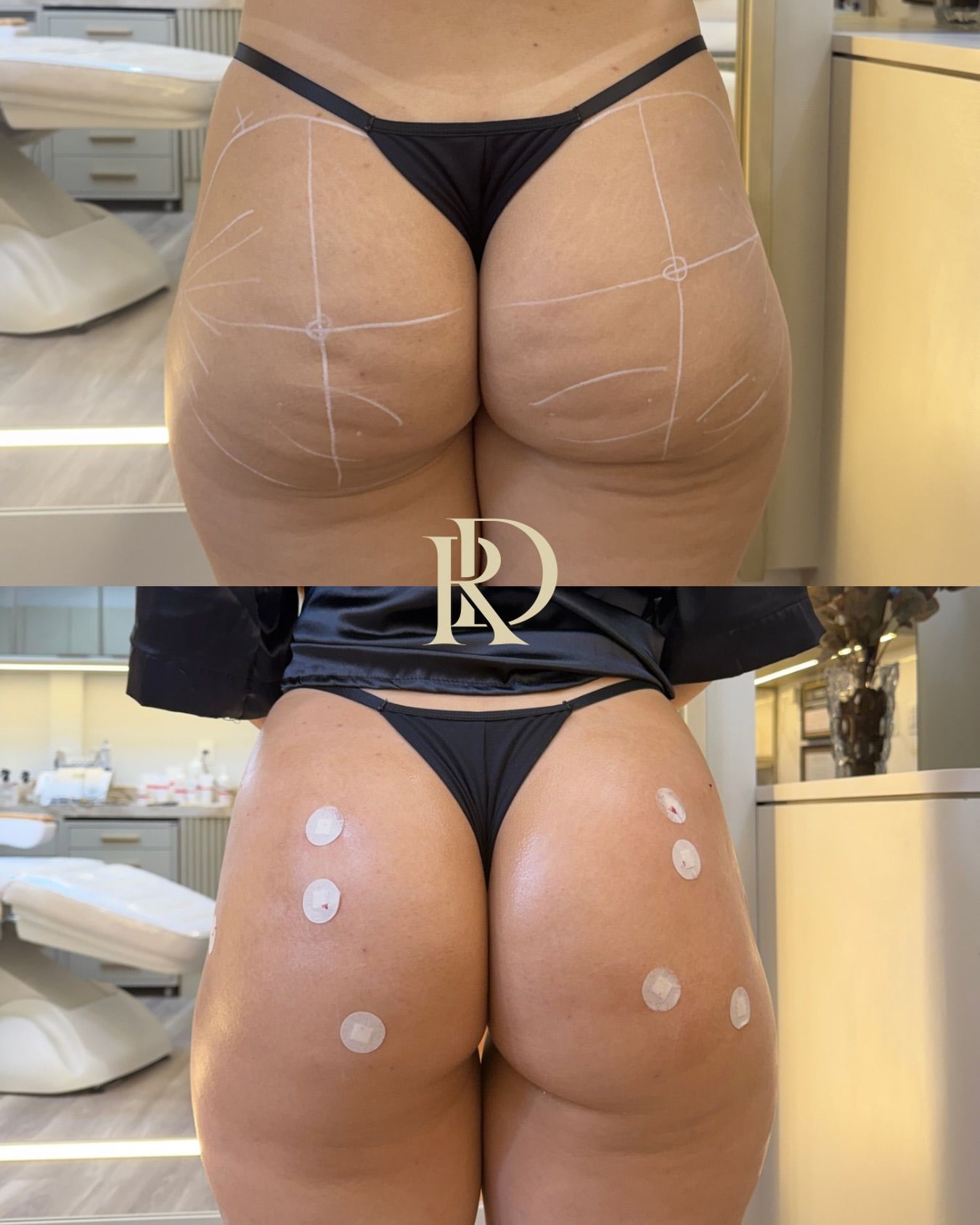 Antes e depois de bioestimulador corporal de glúteos na Clínica Raynara Diniz, Fortaleza