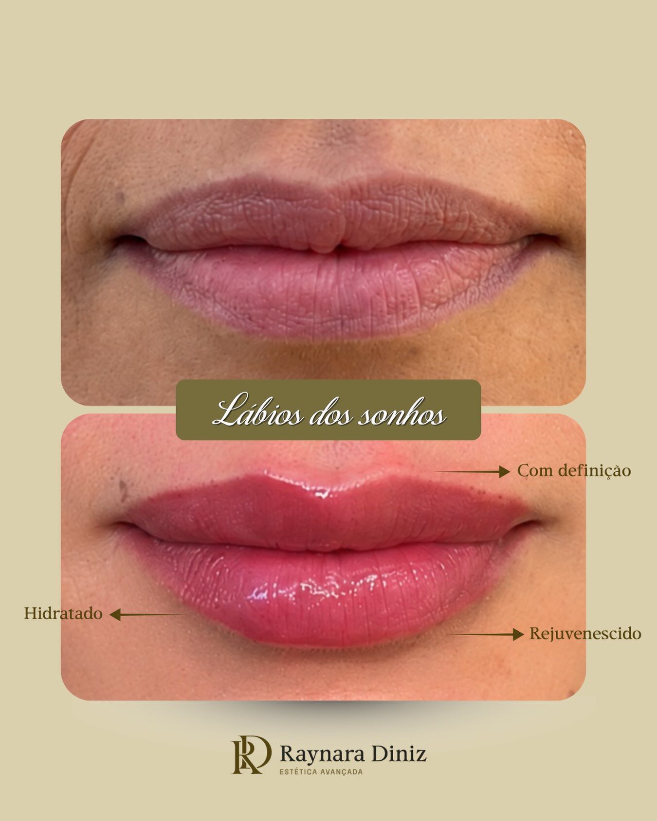 Antes e depois de preenchimento labial com ácido hialurônico na Clínica Raynara Diniz, Fortaleza