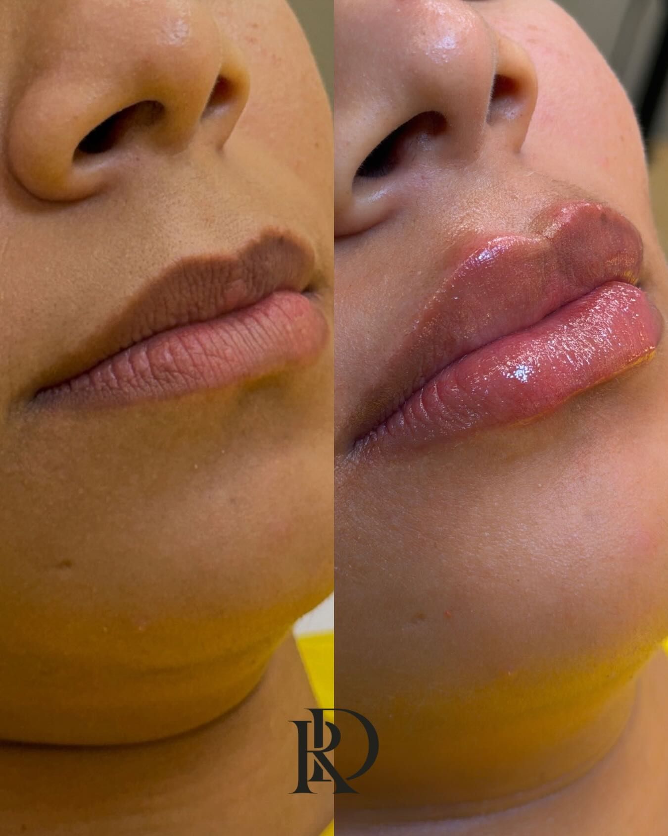 Antes e depois de preenchimento labial (perfil) na Clínica Raynara Diniz, Fortaleza